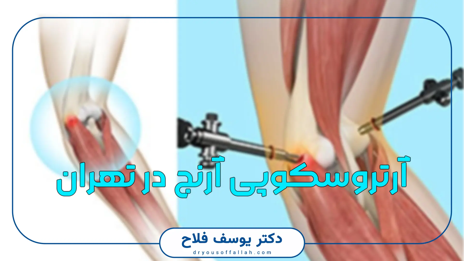 آرتروسکوپی آرنج در تهران