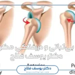 Shoulder instability surgery