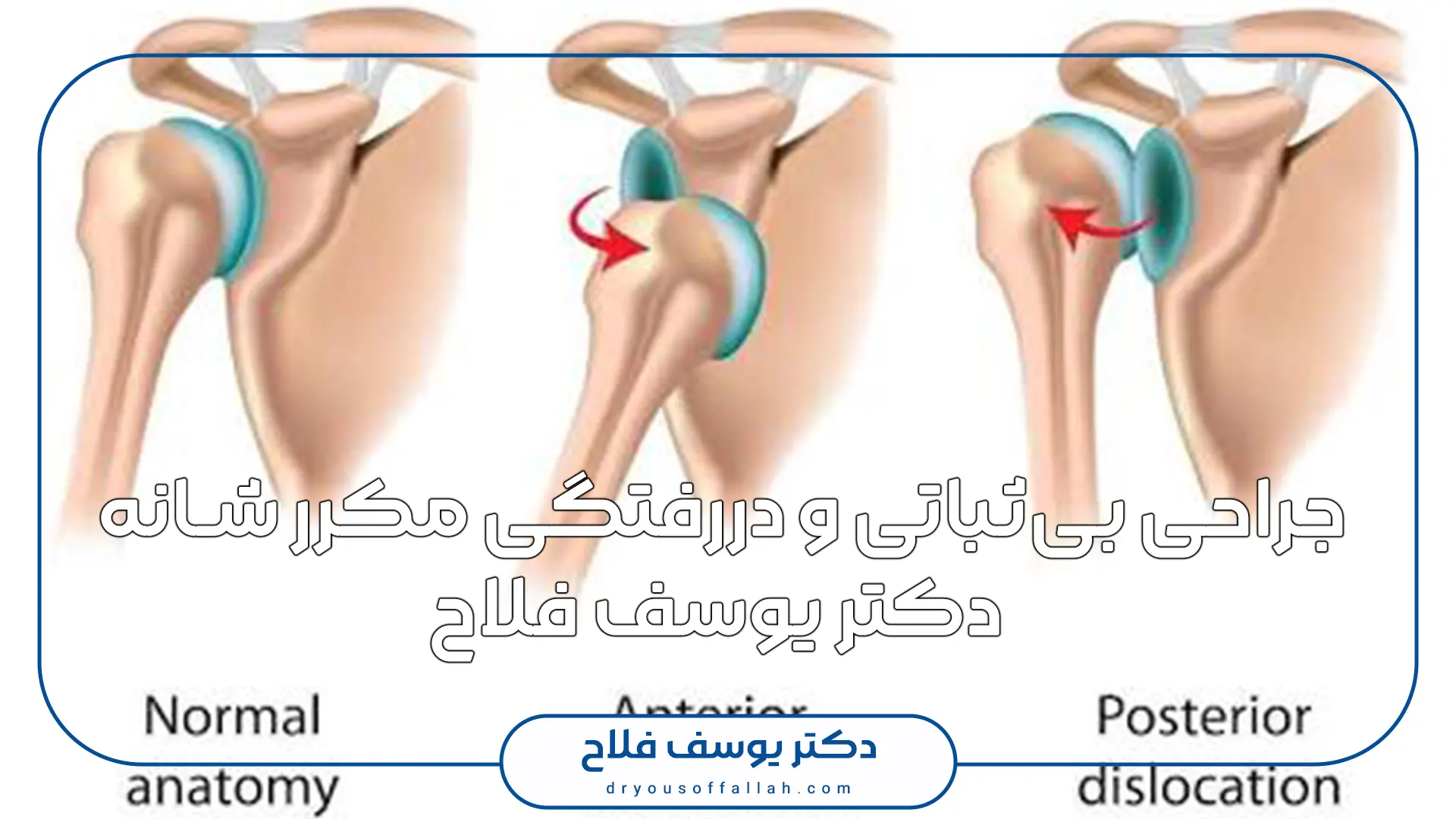 Shoulder instability surgery