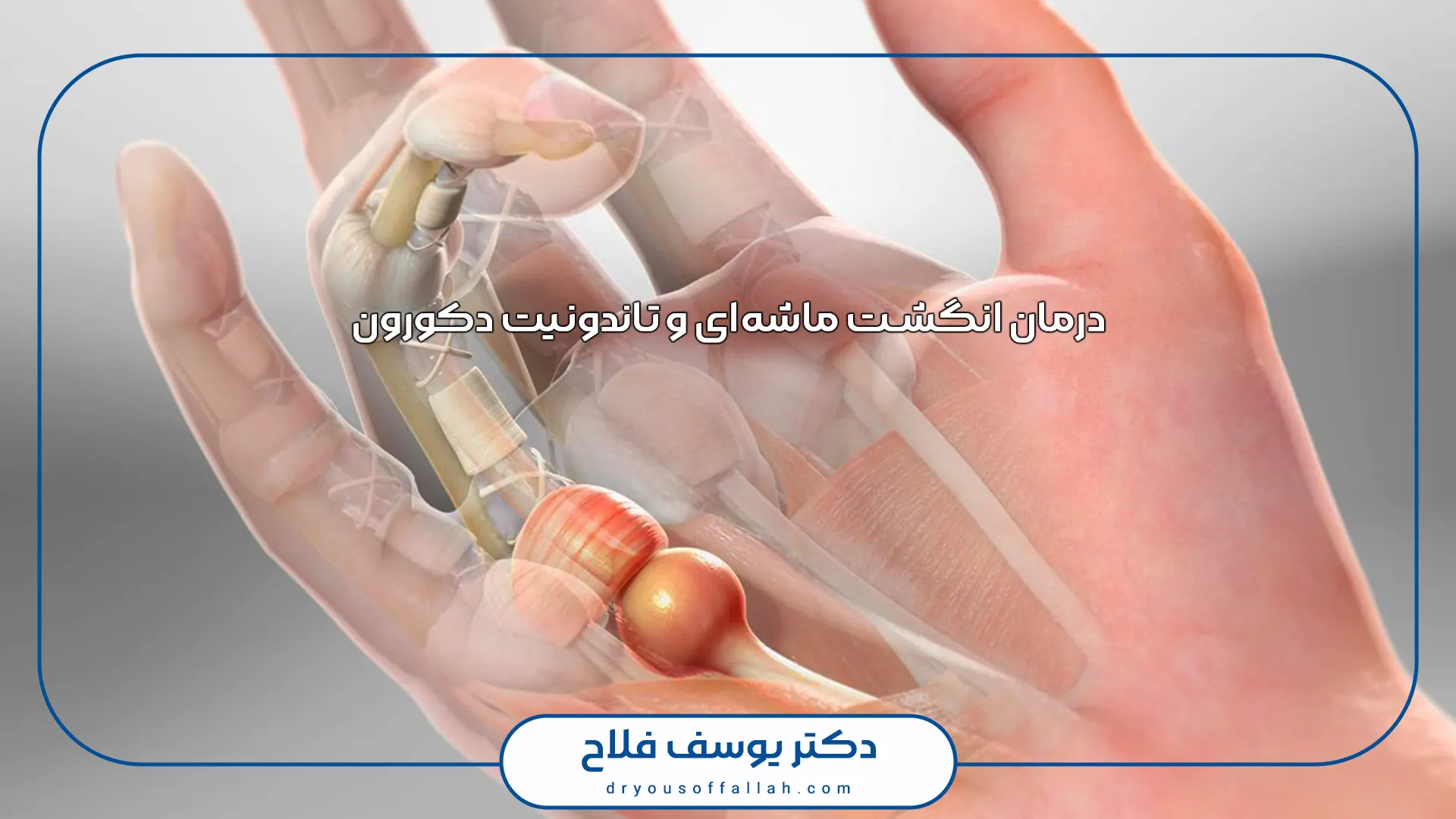 درمان انگشت ماشه‌ای و تاندونیت دکورون: تزریق یا جراحی؟