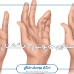 درمان بیماری دوپویترن | انگشتان خمیده