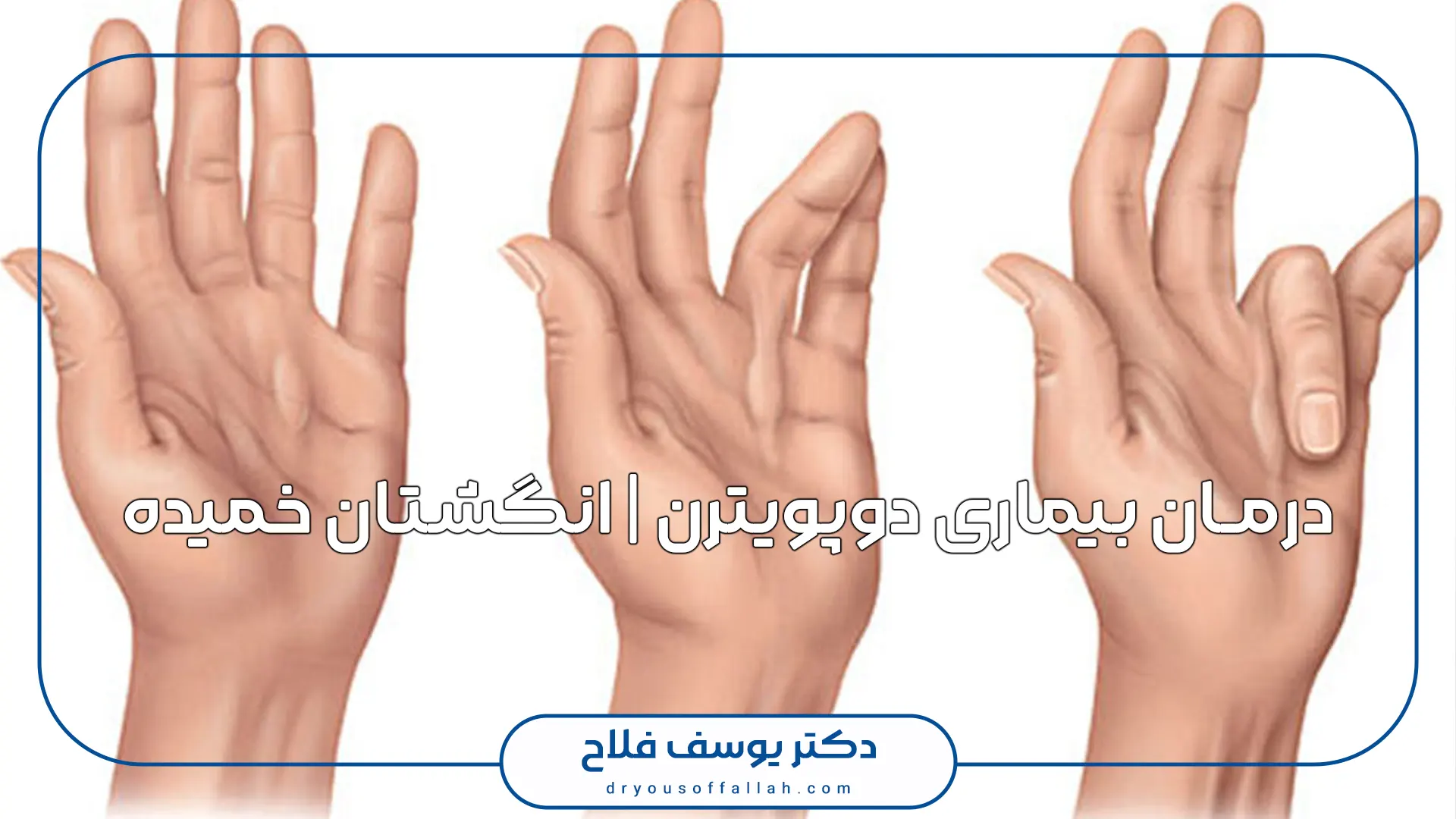 درمان بیماری دوپویترن | انگشتان خمیده