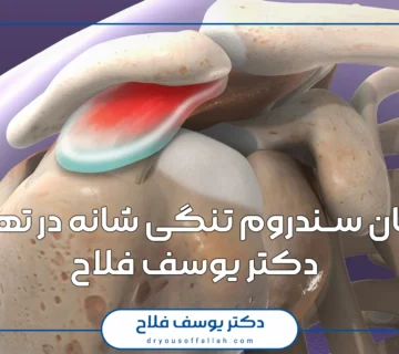 درمان سندروم تنگی شانه در تهران | دکتر یوسف فلاح