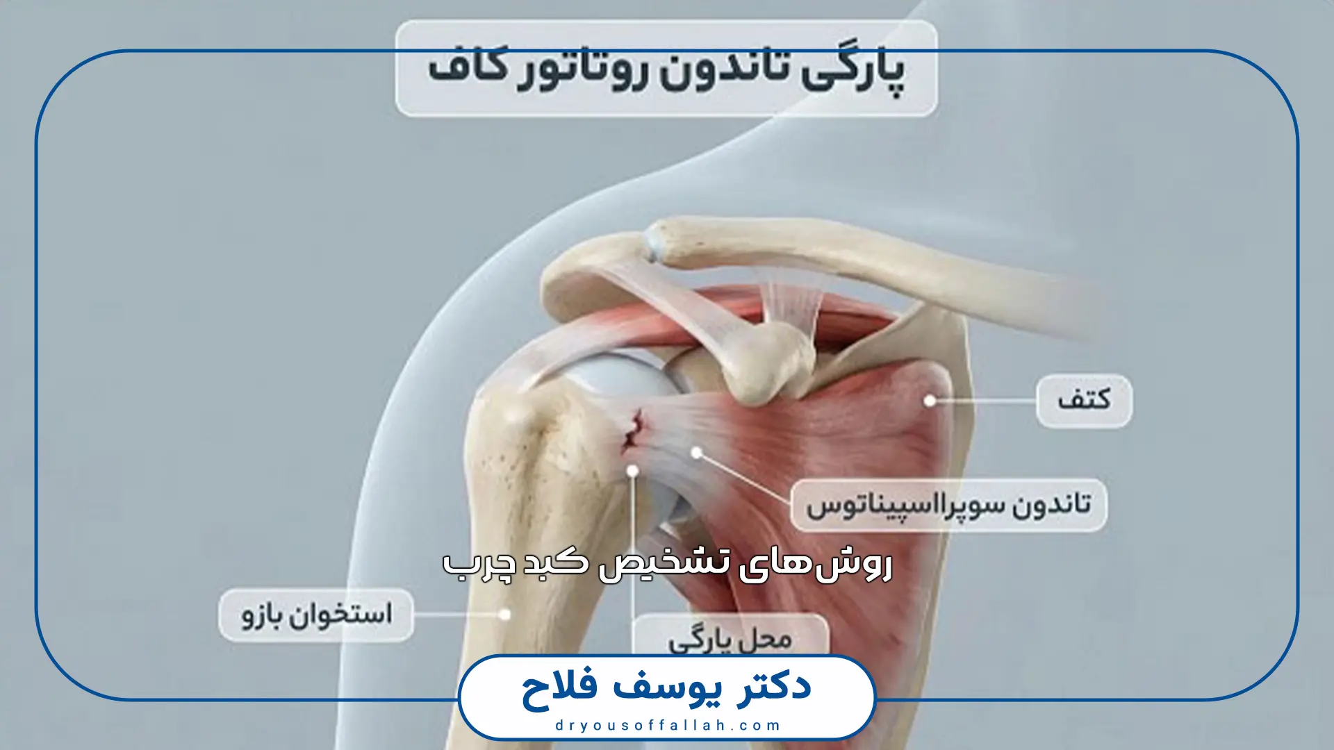 درمان پارگی روتاتور کاف