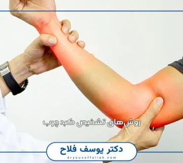 سندروم تونل کوبیتال