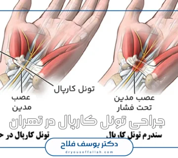 جراحی تونل کارپال در تهران