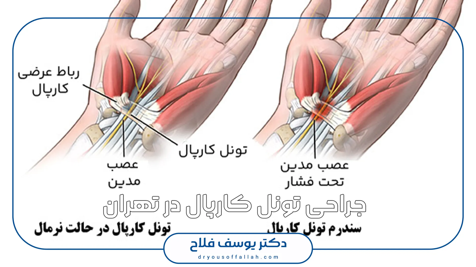 جراحی تونل کارپال در تهران