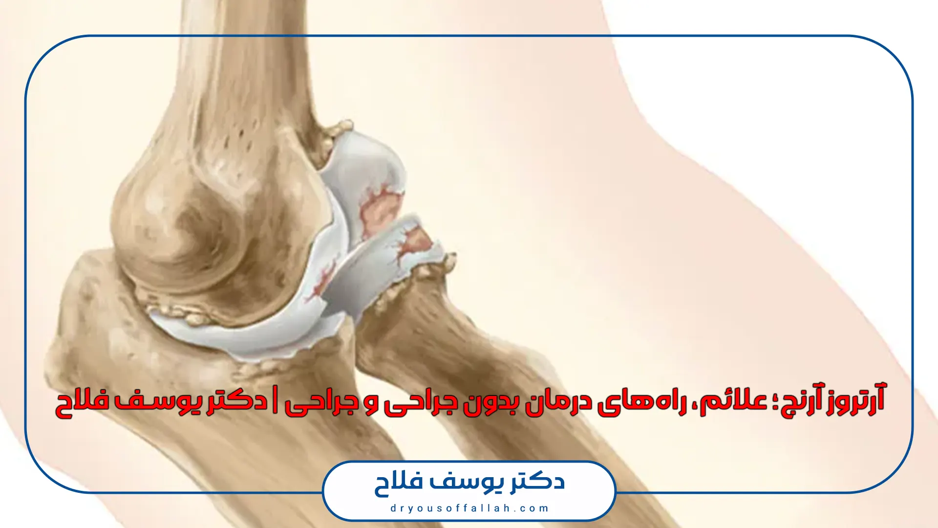 آرتروز آرنج؛ علائم، راه‌های درمان بدون جراحی و جراحی | دکتر یوسف فلاح
