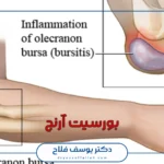 بورسیت آرنج چیست