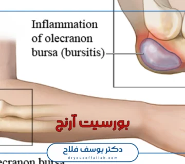 بورسیت آرنج چیست