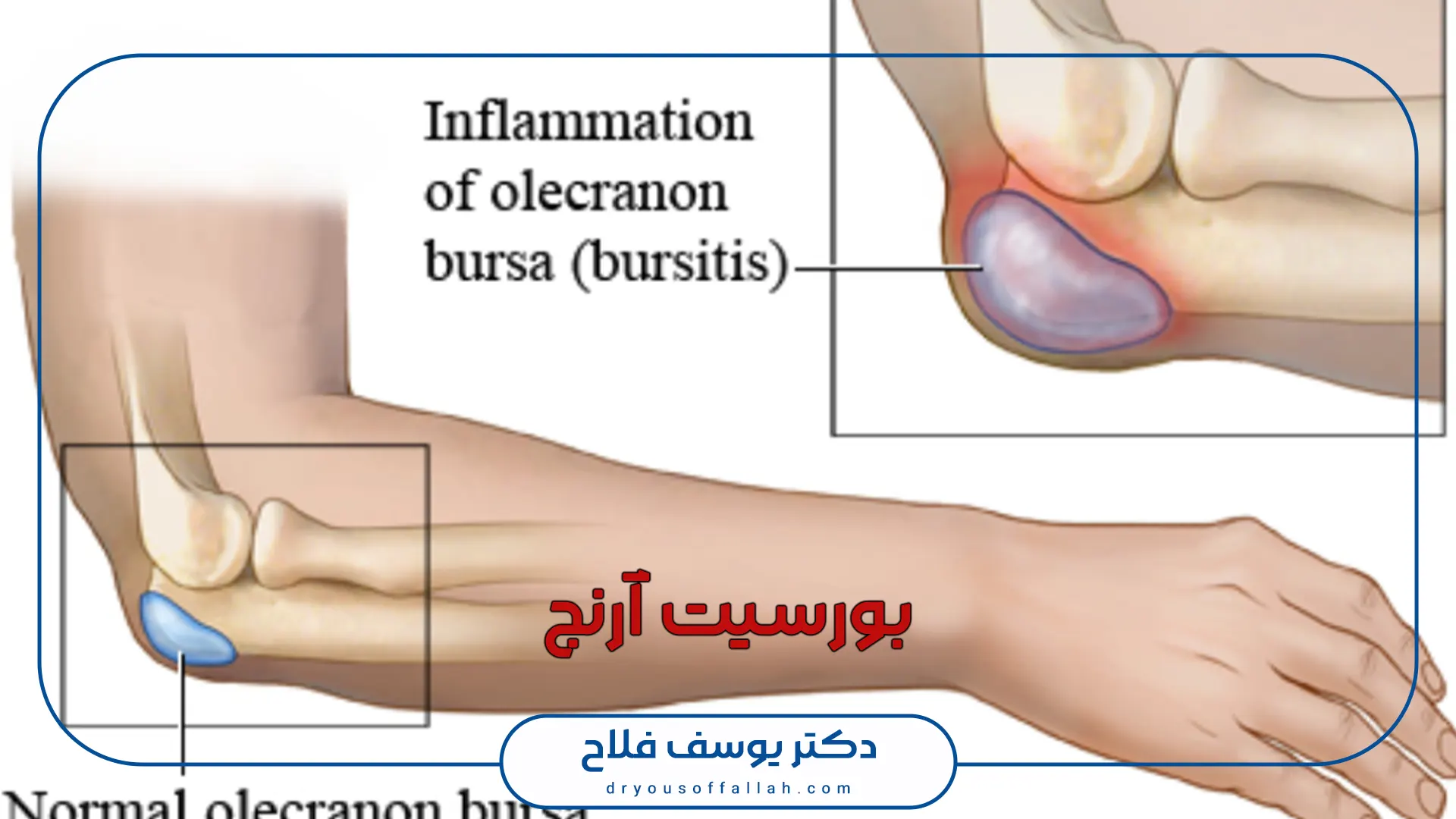 بورسیت آرنج چیست