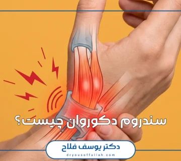 سندروم دکوروان چیست؟
