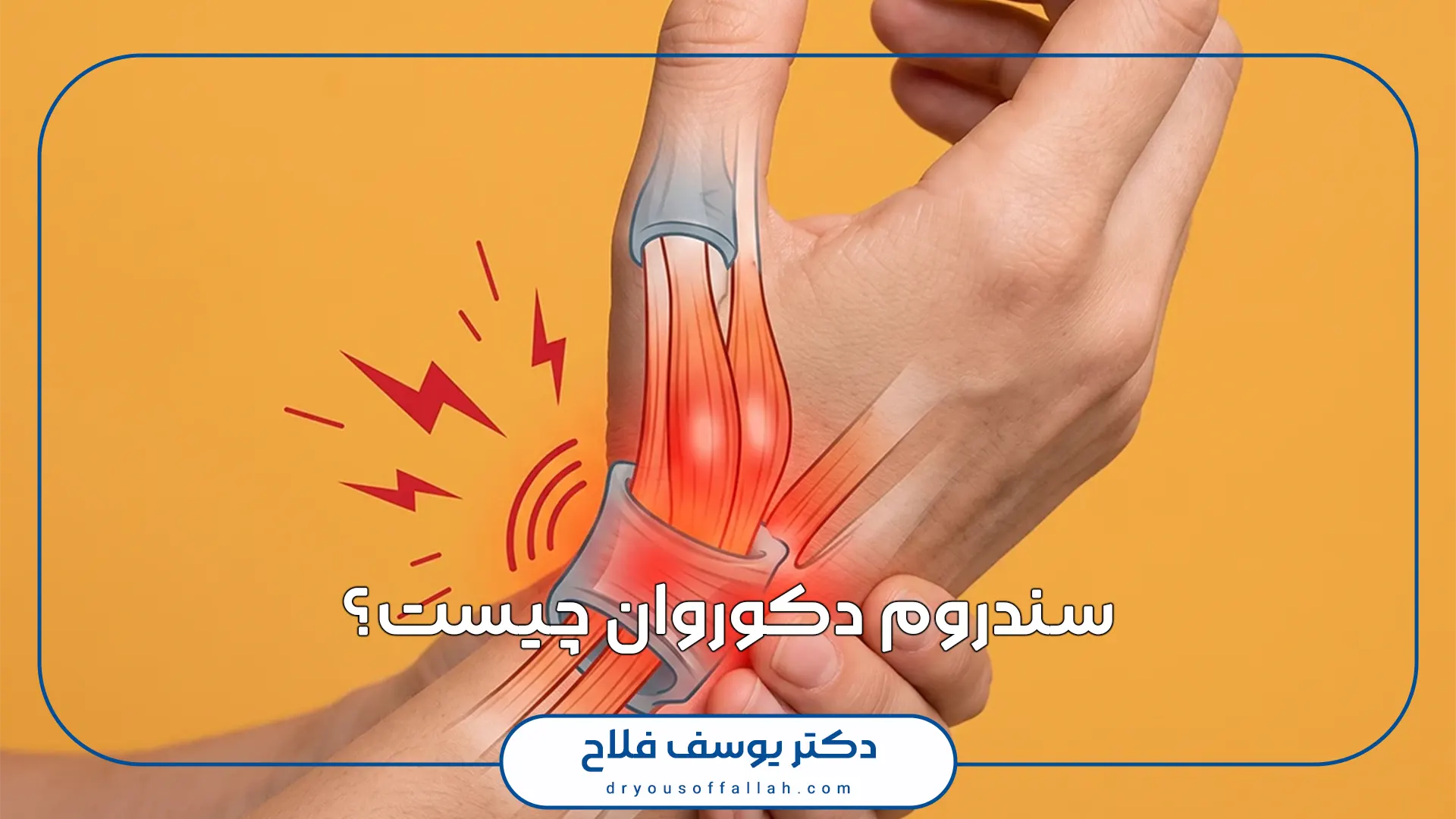 سندروم دکوروان چیست؟