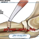 پارگی تاندون دوسر آرنج چیست