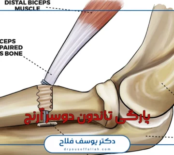 پارگی تاندون دوسر آرنج چیست