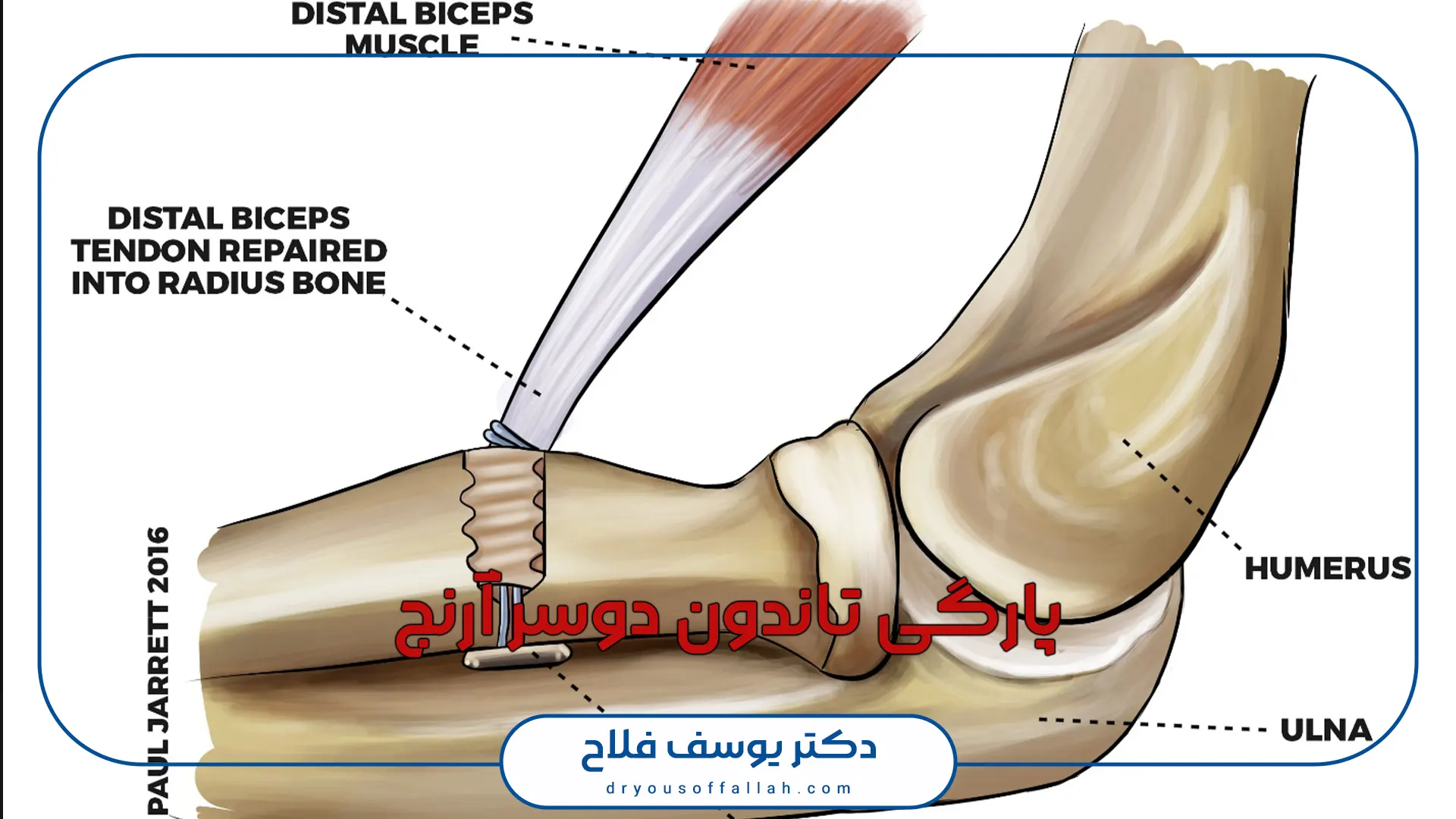 پارگی تاندون دوسر آرنج چیست
